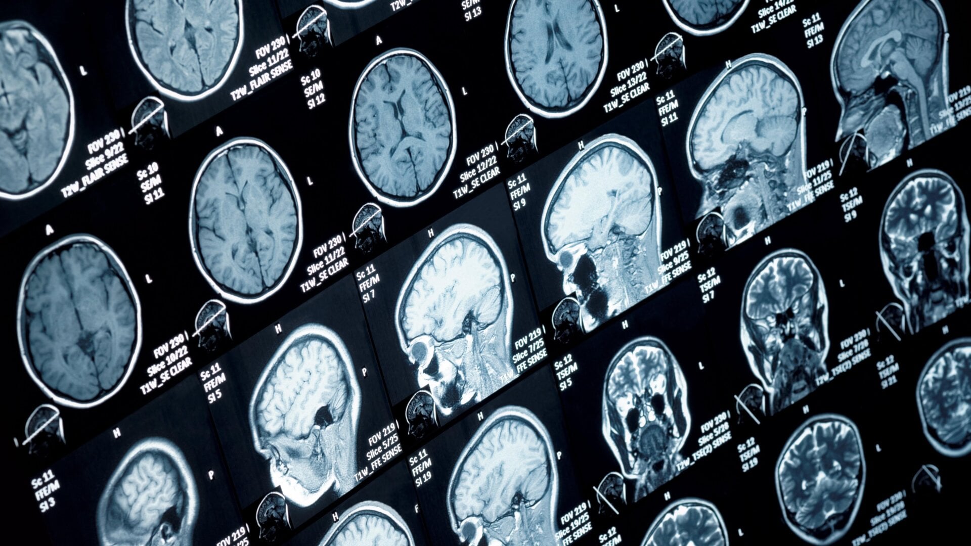 IRM de la tête et du cou.