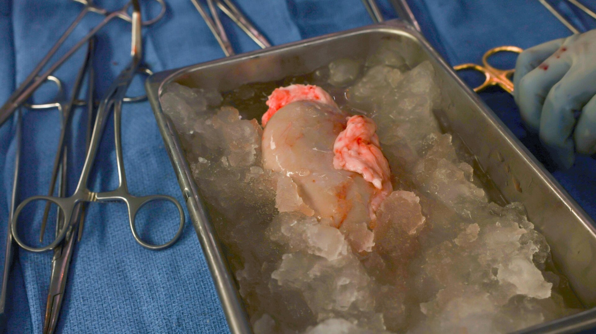 Le nouveau rein de porc de Slayman posé sur la glace, sur le point d’être transplanté.